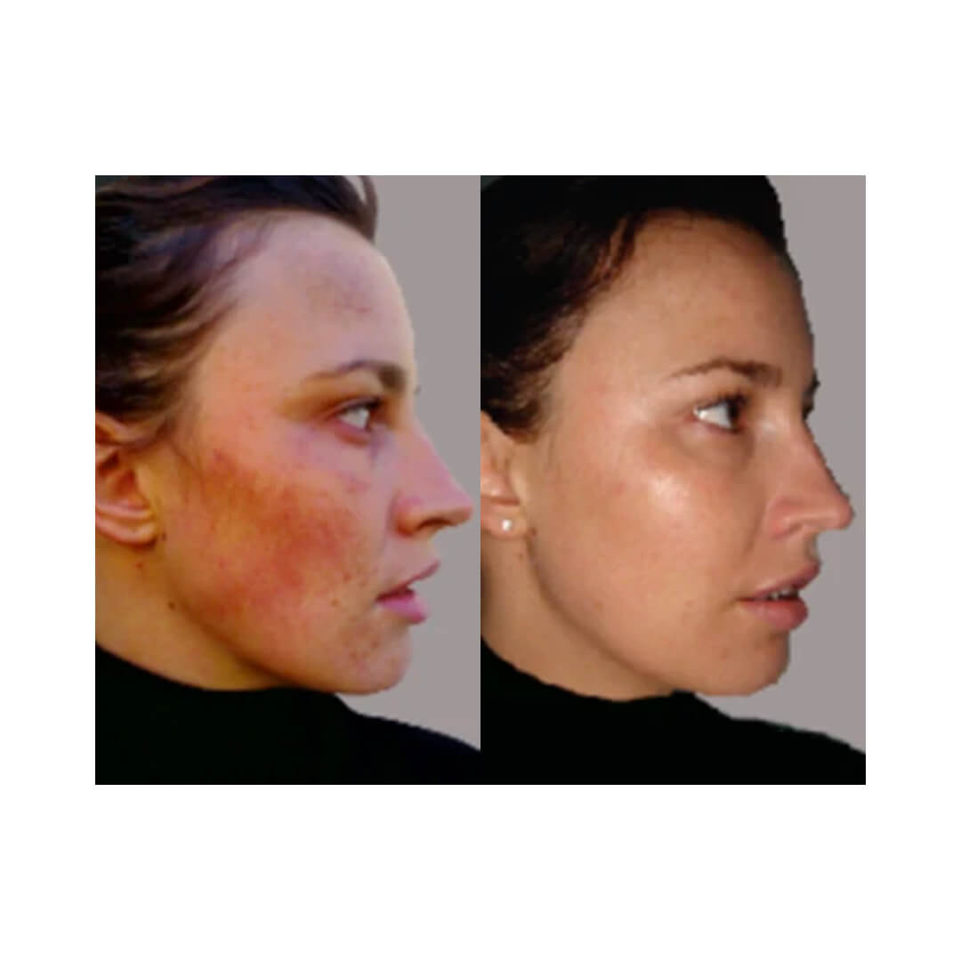 Clear Skin Results Regimen