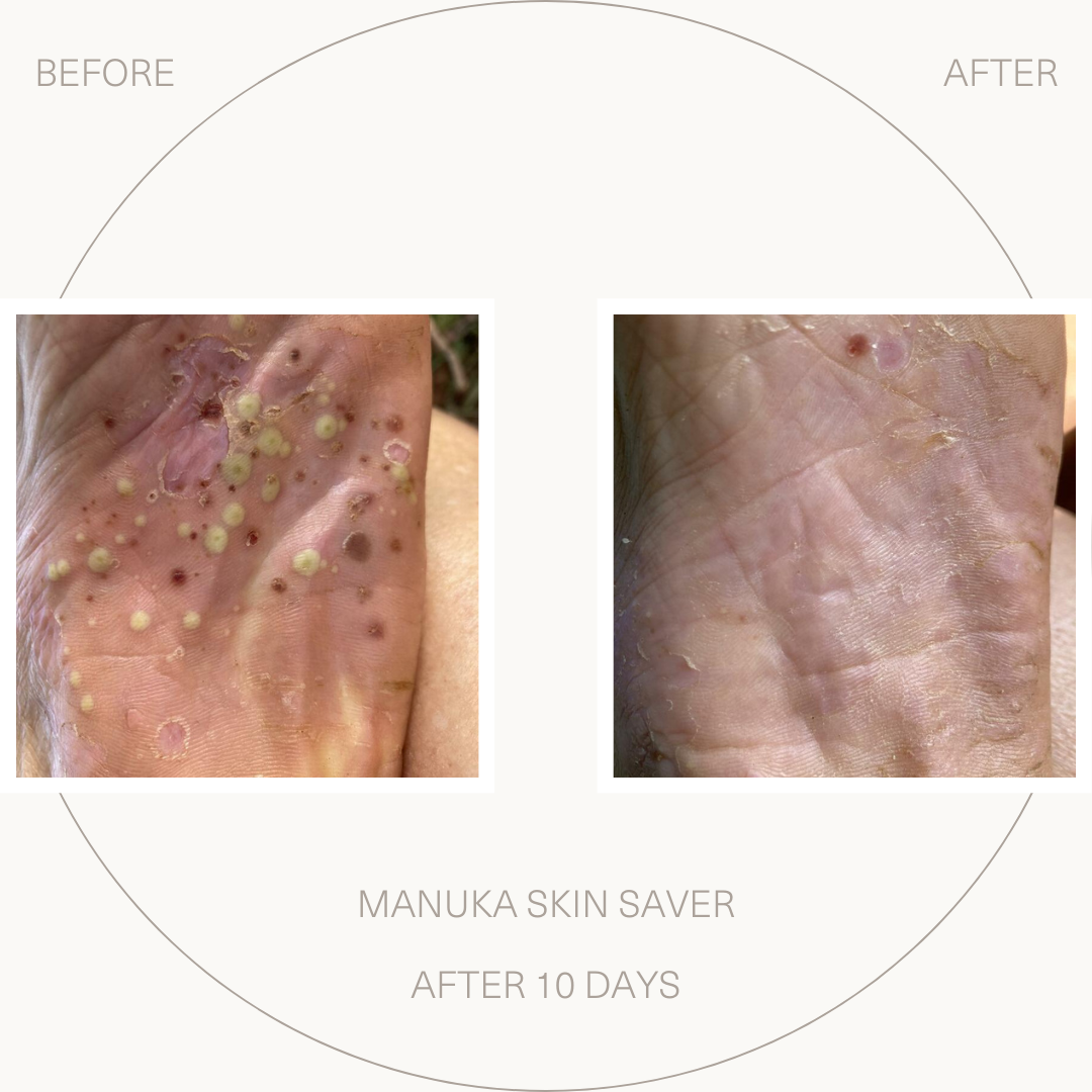 Manuka Skin Saver for Eczema and Psoriasis Prone Skin